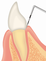 歯周ポケット検査