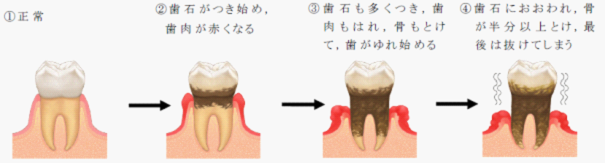 歯周病進行