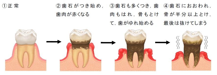 歯周病進行状況